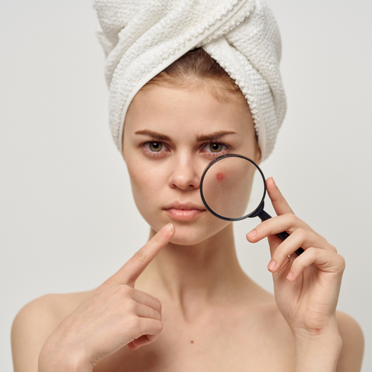 Comment traiter l'acné naturellement ?